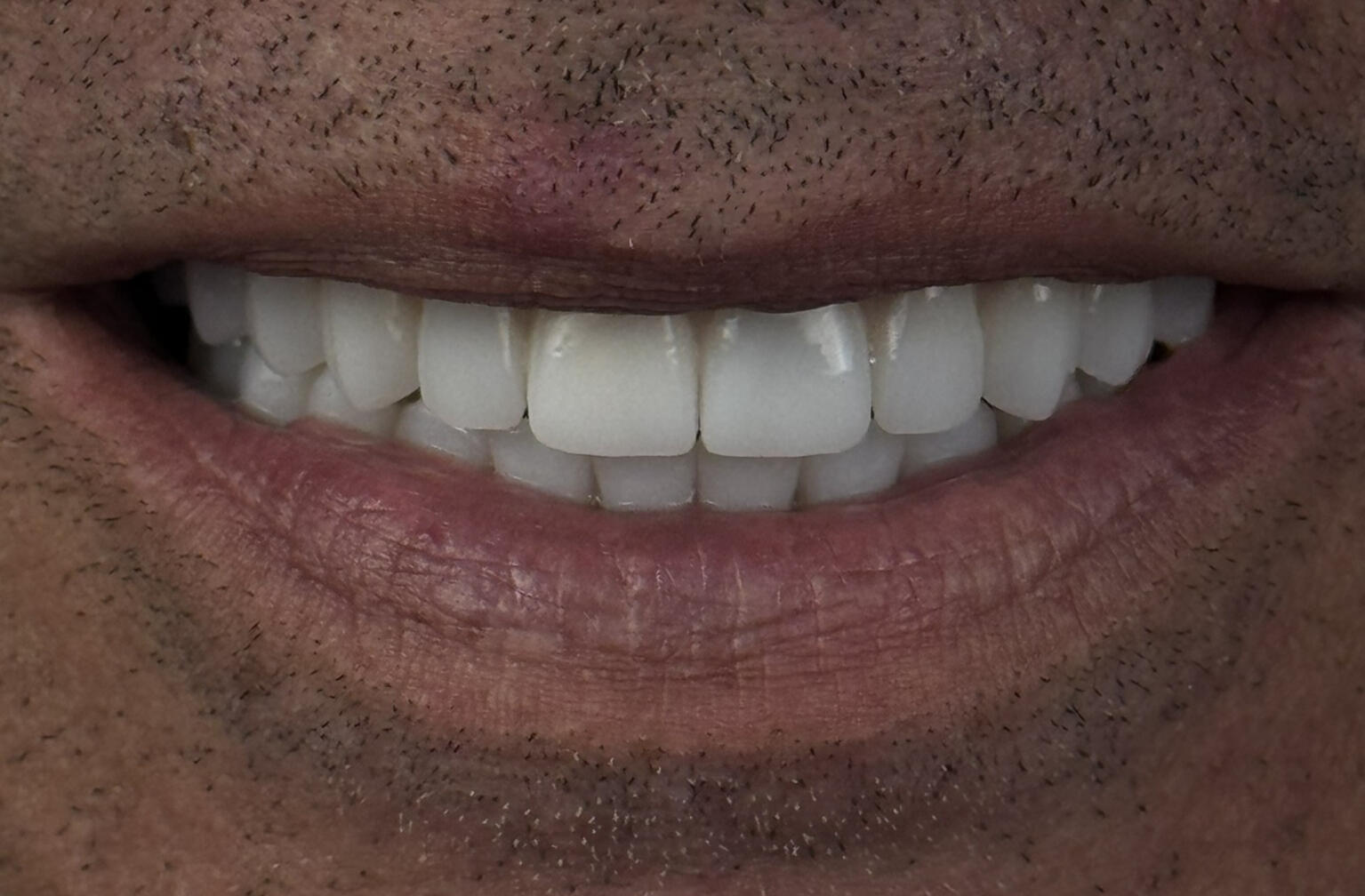 All-on-4 Malo Bridge zirconiu monolitic + titan