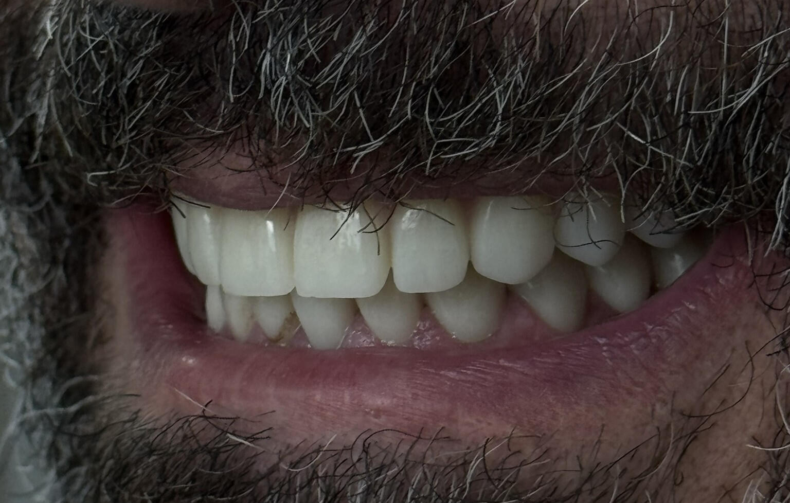 All-on-4 Malo Bridge zirconiu monolitic + titan