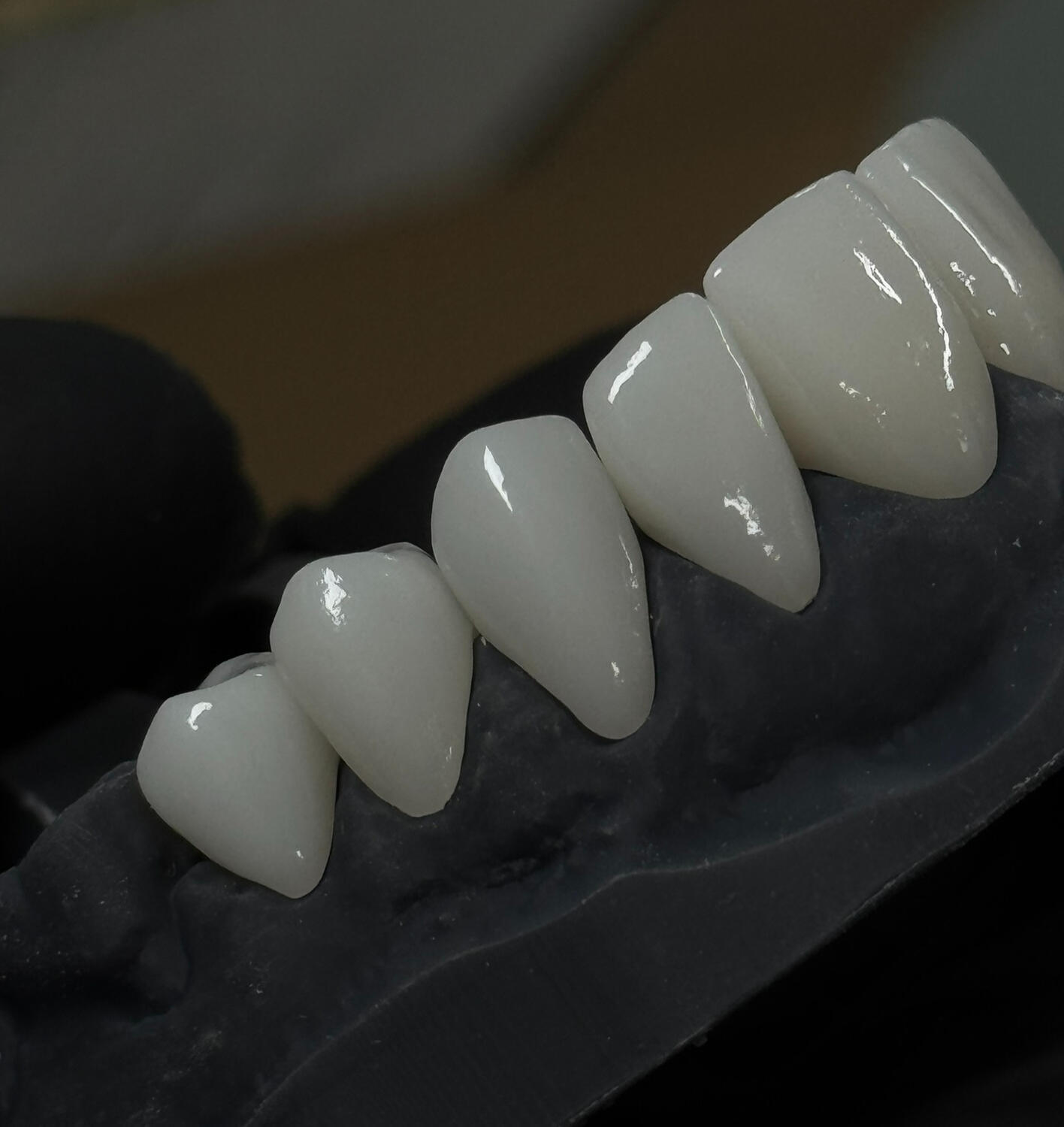 Coroane zirconiu monolitic