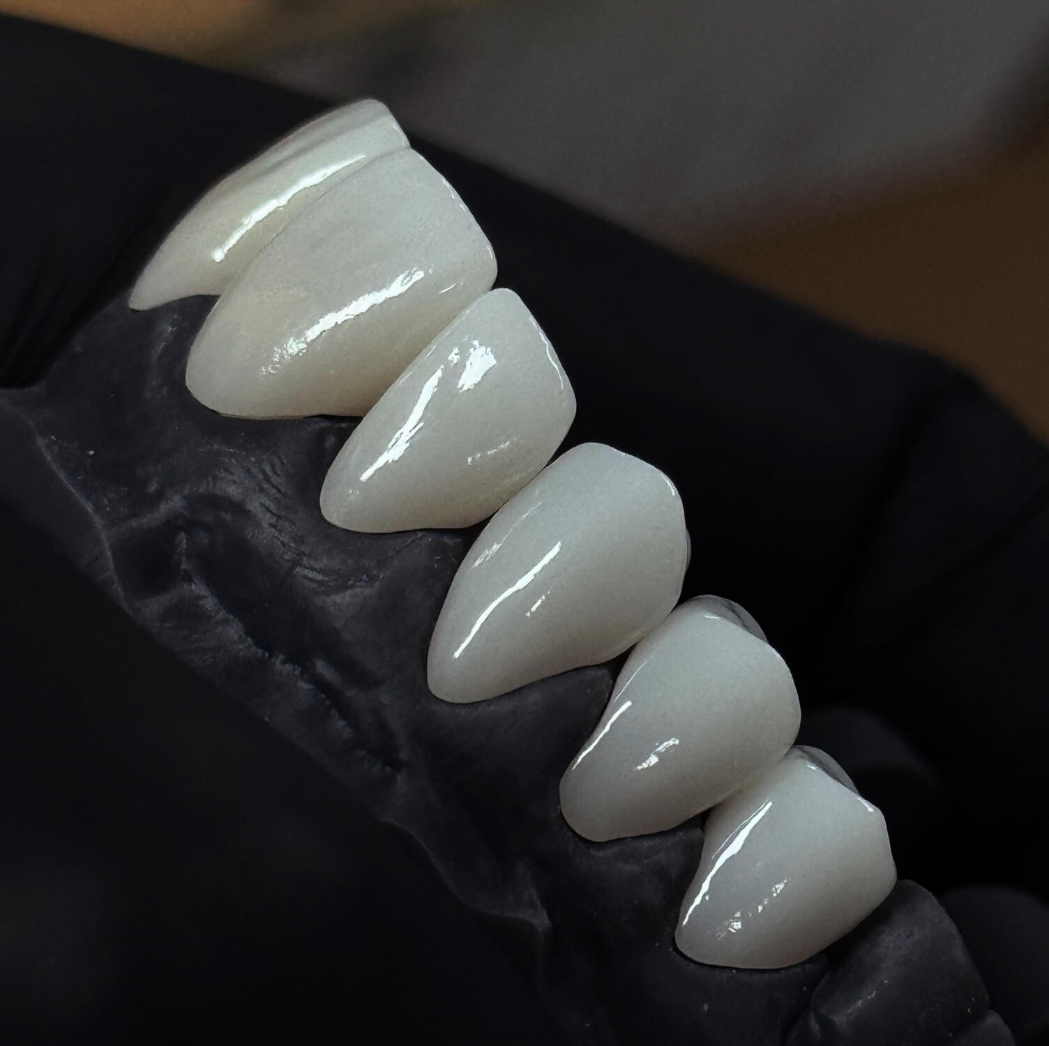 Coroane zirconiu monolitic