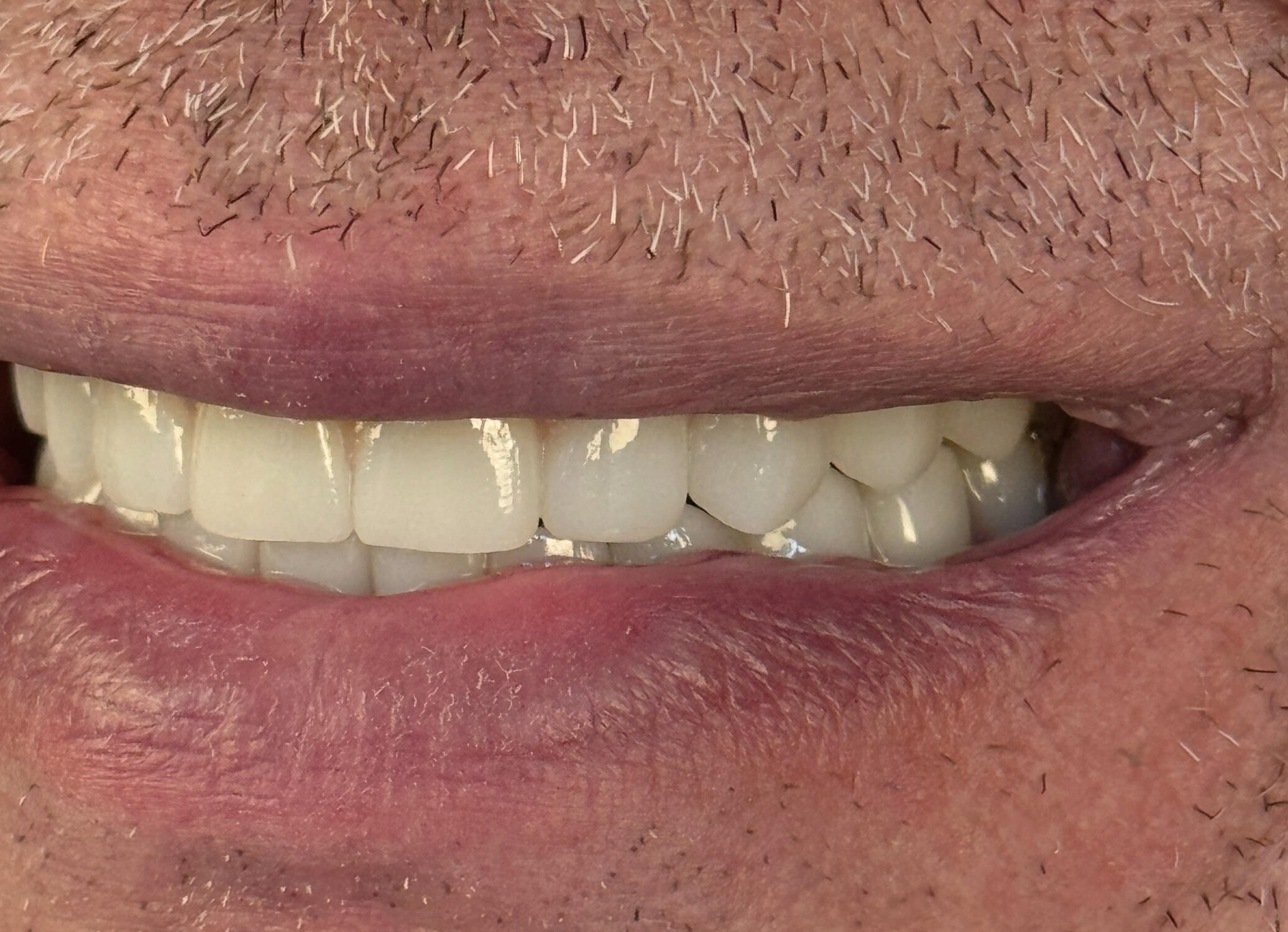 All-on-4 Malo Bridge zirconiu monolitic + titan